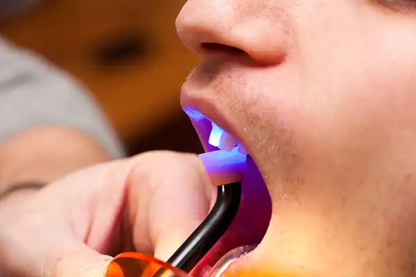 Doctor holding dental bonding light to patient's mouth