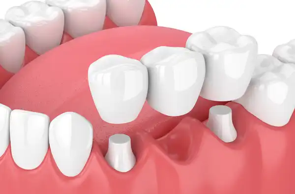 3D rendering of dental bridge