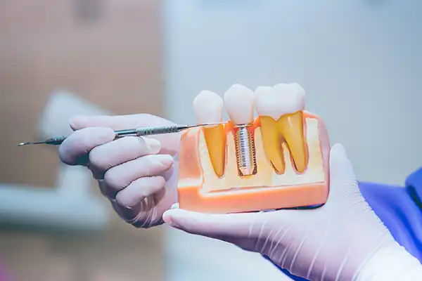 Doctor pointing to model of dental implant in jaw