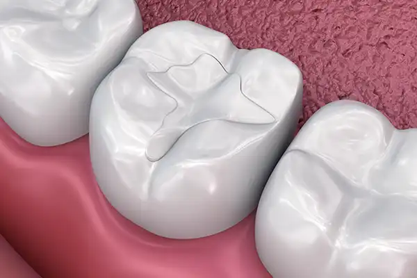 Rendering of dental filling