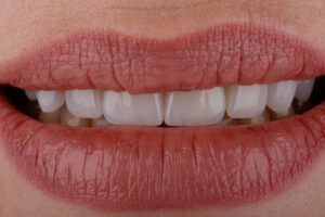 Close-up of a woman's smile showing porcelain veneers